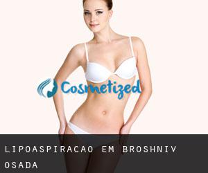 Lipoaspiração em Broshniv-Osada