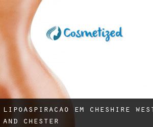 Lipoaspiração em Cheshire West and Chester