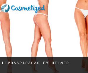 Lipoaspiração em Helmer