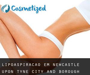 Lipoaspiração em Newcastle upon Tyne (City and Borough)