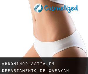 Abdominoplastia em Departamento de Capayán